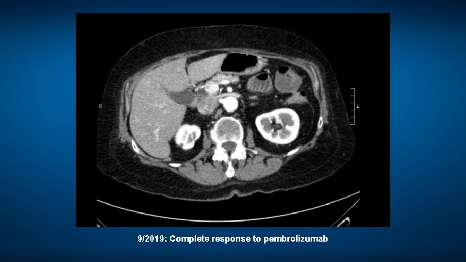 9/2019: Complete response to pembrolizumab 