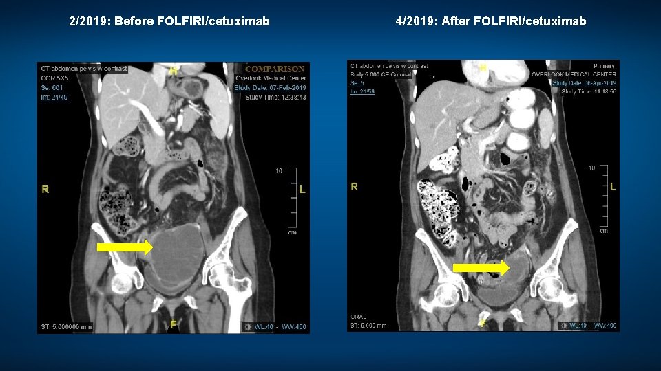 2/2019: Before FOLFIRI/cetuximab 4/2019: After FOLFIRI/cetuximab 