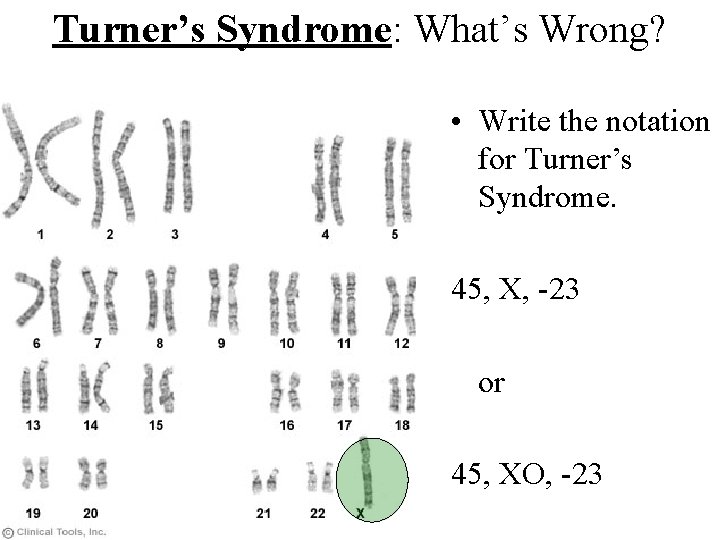 Turner’s Syndrome: What’s Wrong? • Write the notation for Turner’s Syndrome. 45, X, -23