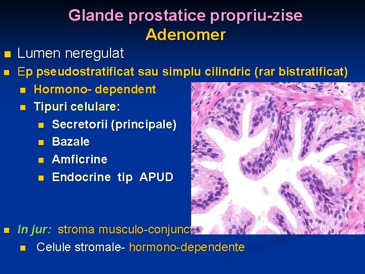 Glande prostatice propriu-zise Adenomer n Lumen neregulat n Ep pseudostratificat sau simplu cilindric (rar