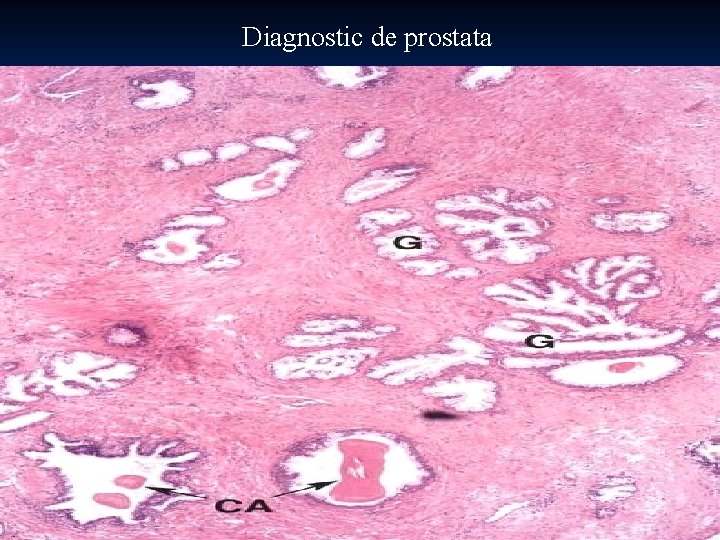 Diagnostic de prostata 73 