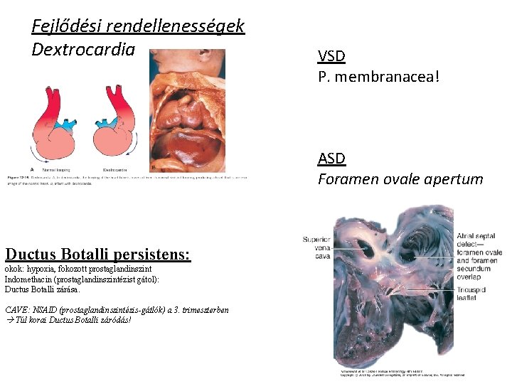 Fejlődési rendellenességek Dextrocardia VSD P. membranacea! ASD Foramen ovale apertum Ductus Botalli persistens: okok: