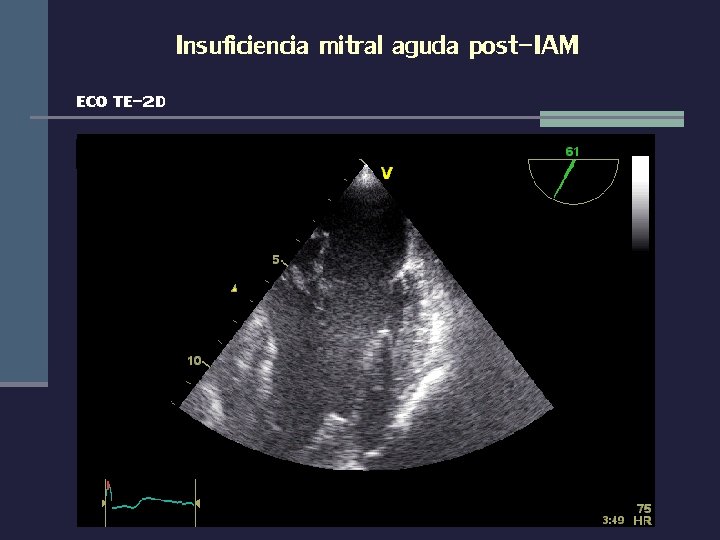 Insuficiencia mitral aguda post-IAM ECO TE-2 D 