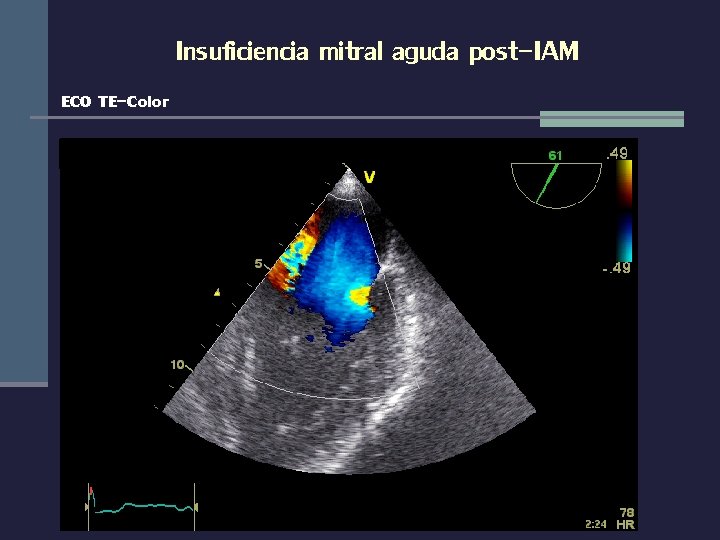 Insuficiencia mitral aguda post-IAM ECO TE-Color 