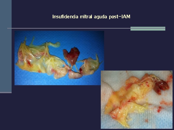 Insuficiencia mitral aguda post-IAM 