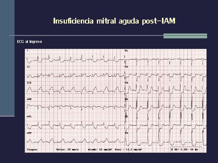 Insuficiencia mitral aguda post-IAM ECG al ingreso 