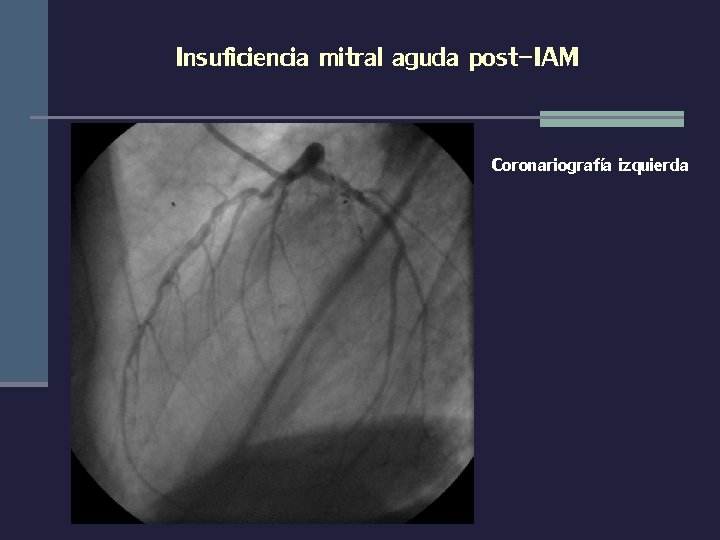 Insuficiencia mitral aguda post-IAM Coronariografía izquierda 