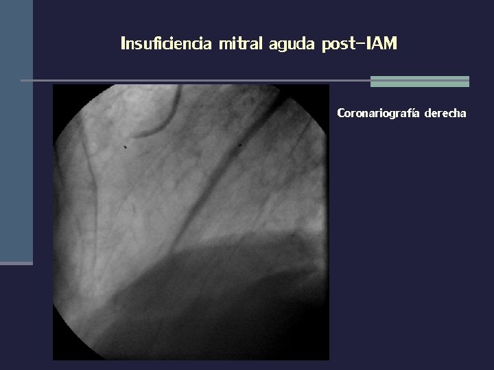 Insuficiencia mitral aguda post-IAM Coronariografía derecha 