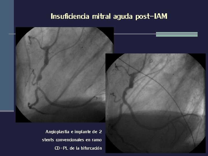 Insuficiencia mitral aguda post-IAM Angioplastia e implante de 2 stents convencionales en ramo CD-PL