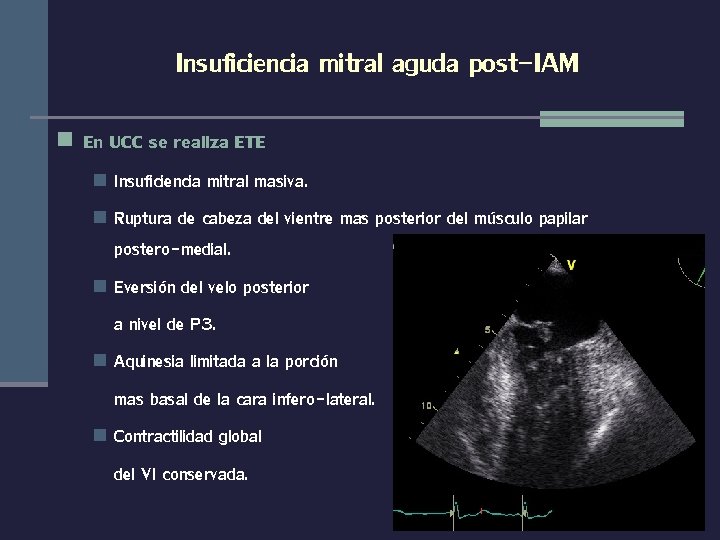 Insuficiencia mitral aguda post-IAM n En UCC se realiza ETE Insuficiencia mitral masiva. n