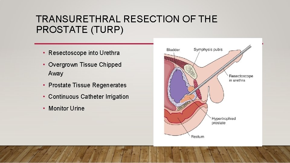 TRANSURETHRAL RESECTION OF THE PROSTATE (TURP) • Resectoscope into Urethra • Overgrown Tissue Chipped