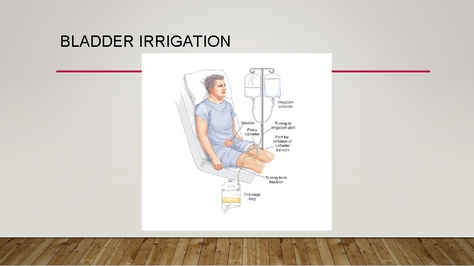 BLADDER IRRIGATION 