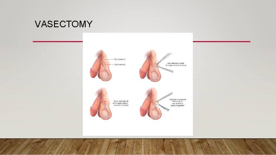 VASECTOMY 