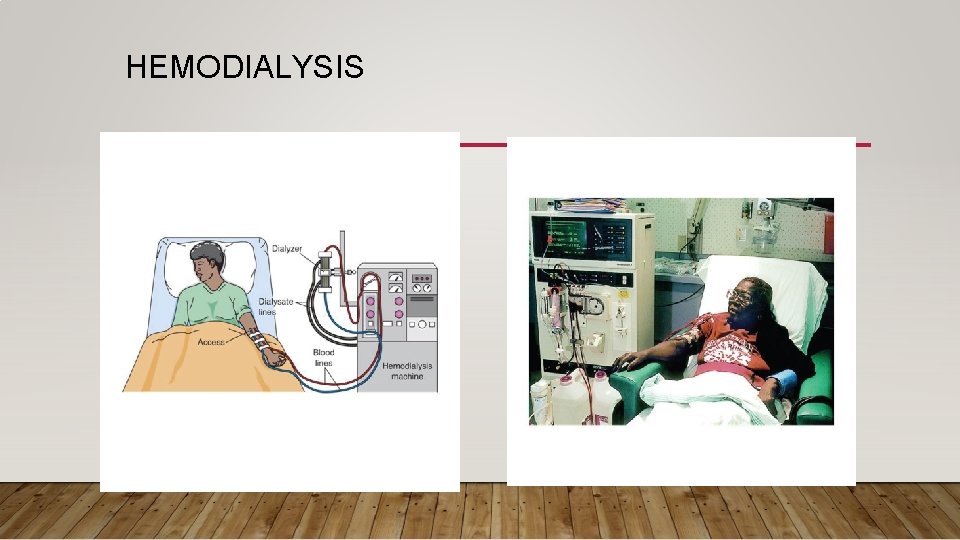  HEMODIALYSIS 