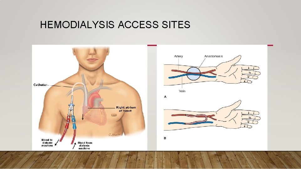  HEMODIALYSIS ACCESS SITES 