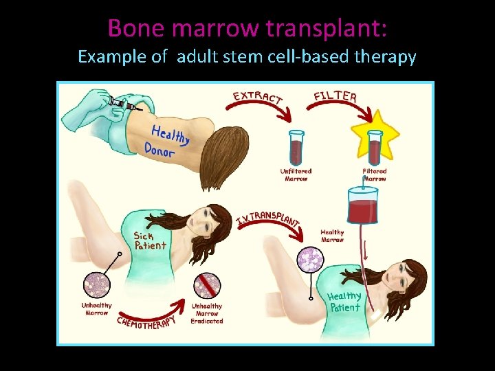 Bone marrow transplant: Example of adult stem cell-based therapy 