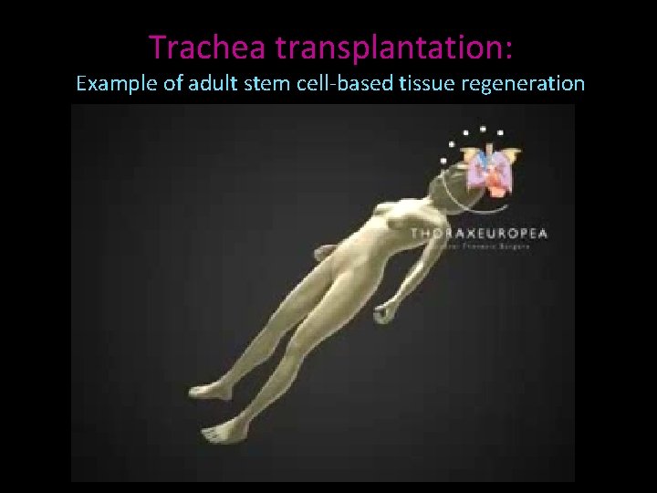 Trachea transplantation: Example of adult stem cell-based tissue regeneration 
