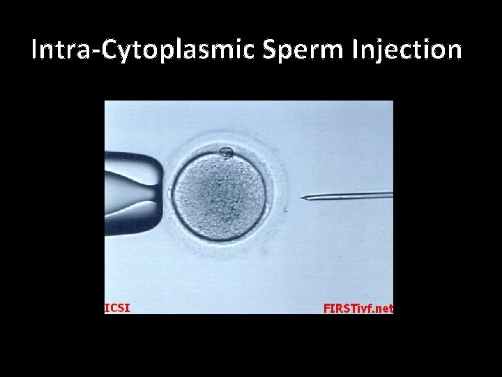Intra-Cytoplasmic Sperm Injection 