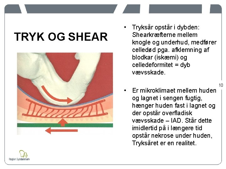 TRYK OG SHEAR • Tryksår opstår i dybden: Shearkræfterne mellem knogle og underhud, medfører