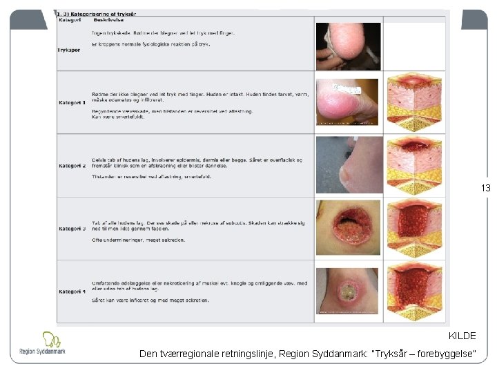 13 KILDE Den tværregionale retningslinje, Region Syddanmark: ”Tryksår – forebyggelse” 
