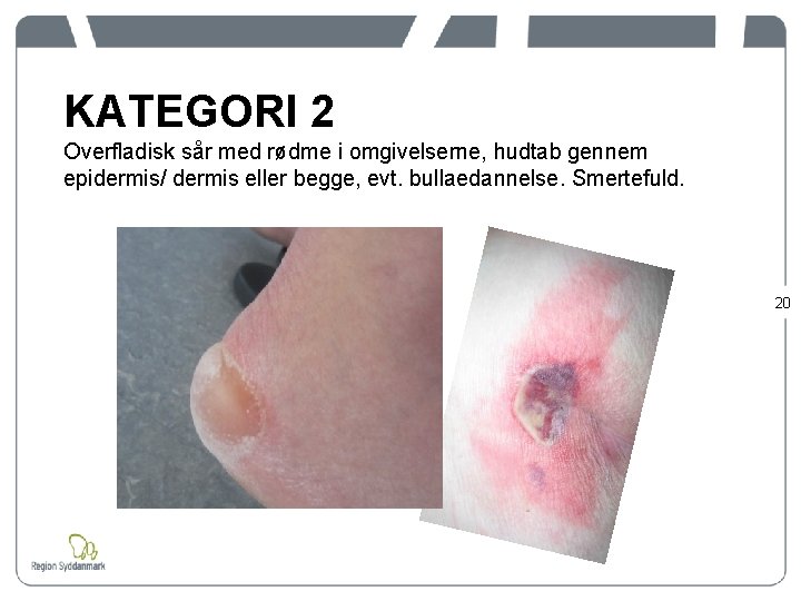 KATEGORI 2 Overfladisk sår med rødme i omgivelserne, hudtab gennem epidermis/ dermis eller begge,