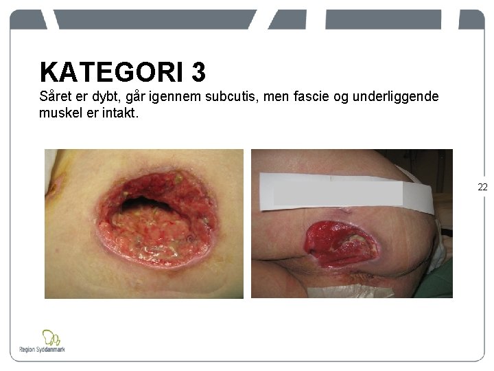 KATEGORI 3 Såret er dybt, går igennem subcutis, men fascie og underliggende muskel er