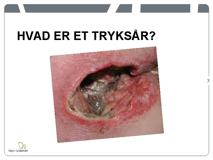 HVAD ER ET TRYKSÅR? 3 