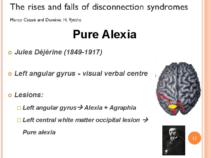 Pure Alexia Jules Déjérine (1849 -1917) Left angular gyrus = visual verbal centre Lesions: