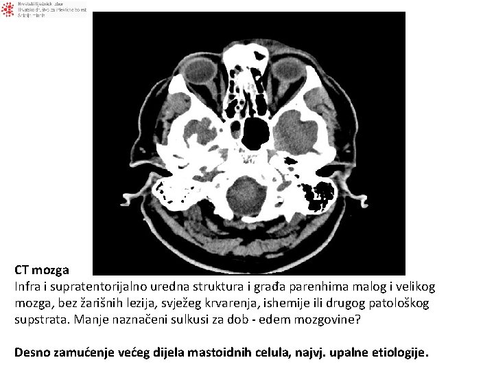 CT mozga Infra i supratentorijalno uredna struktura i građa parenhima malog i velikog mozga,