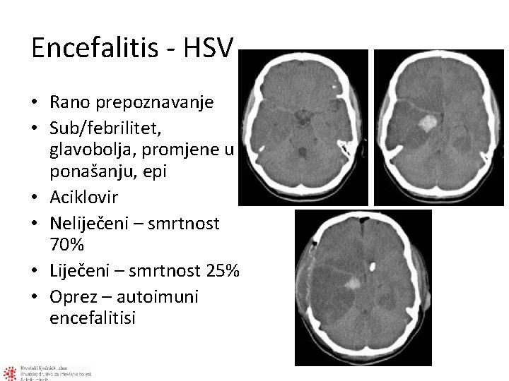 Encefalitis - HSV • Rano prepoznavanje • Sub/febrilitet, glavobolja, promjene u ponašanju, epi •
