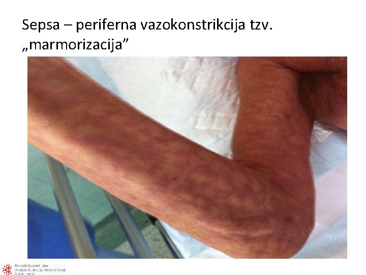 Sepsa – periferna vazokonstrikcija tzv. „marmorizacija” 