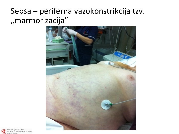 Sepsa – periferna vazokonstrikcija tzv. „marmorizacija” 