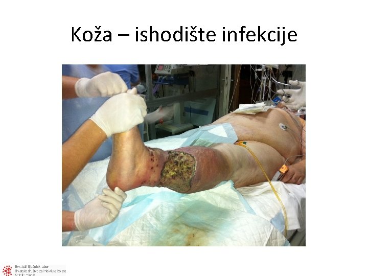 Koža – ishodište infekcije 