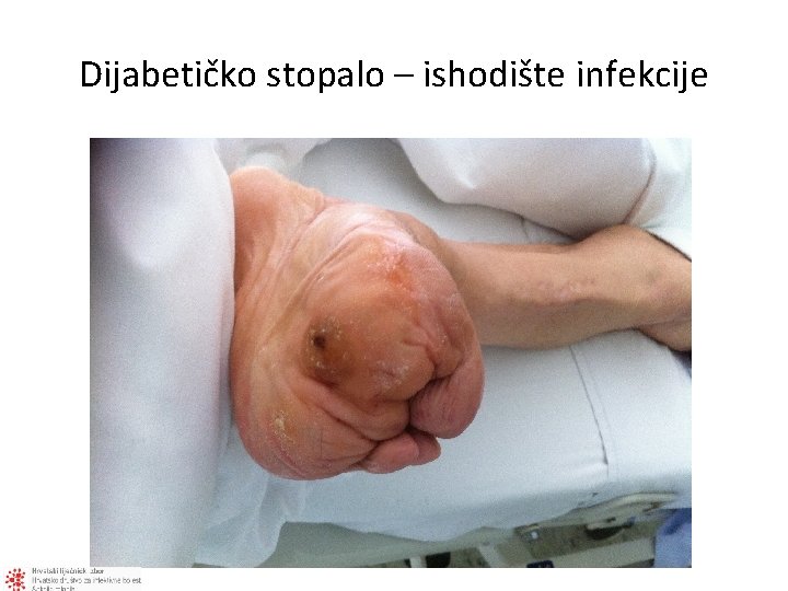 Dijabetičko stopalo – ishodište infekcije 