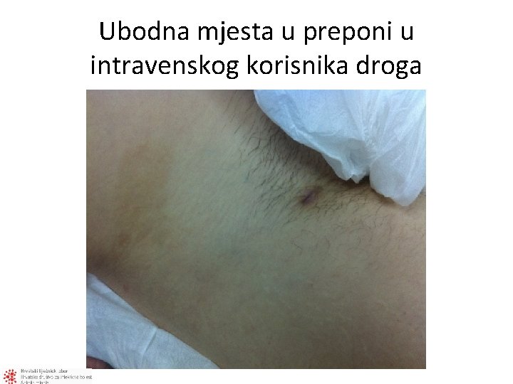 Ubodna mjesta u preponi u intravenskog korisnika droga 