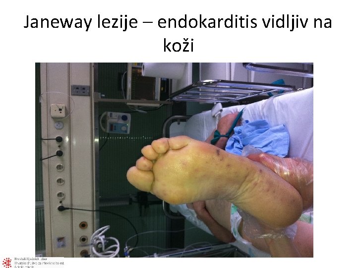 Janeway lezije – endokarditis vidljiv na koži 