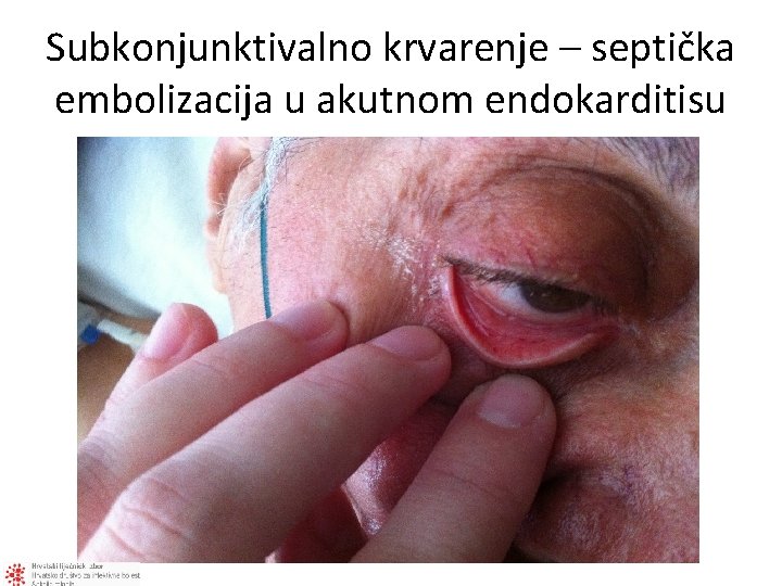 Subkonjunktivalno krvarenje – septička embolizacija u akutnom endokarditisu 