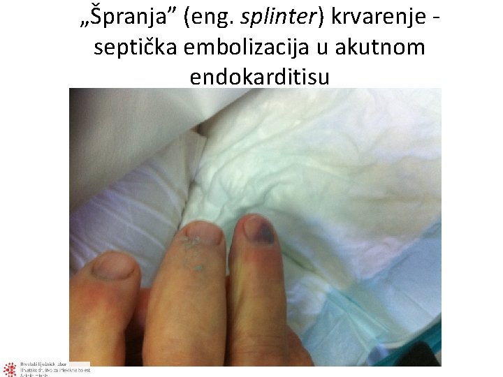 „Špranja” (eng. splinter) krvarenje - septička embolizacija u akutnom endokarditisu 