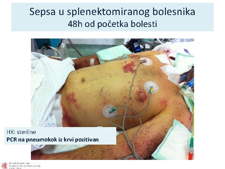 Sepsa u splenektomiranog bolesnika 48 h od početka bolesti HK: sterilne PCR na pneumokok