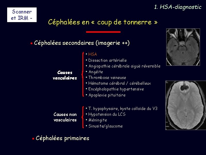 Scanner et IRM - 1. HSA-diagnostic Céphalées en « coup de tonnerre » Céphalées