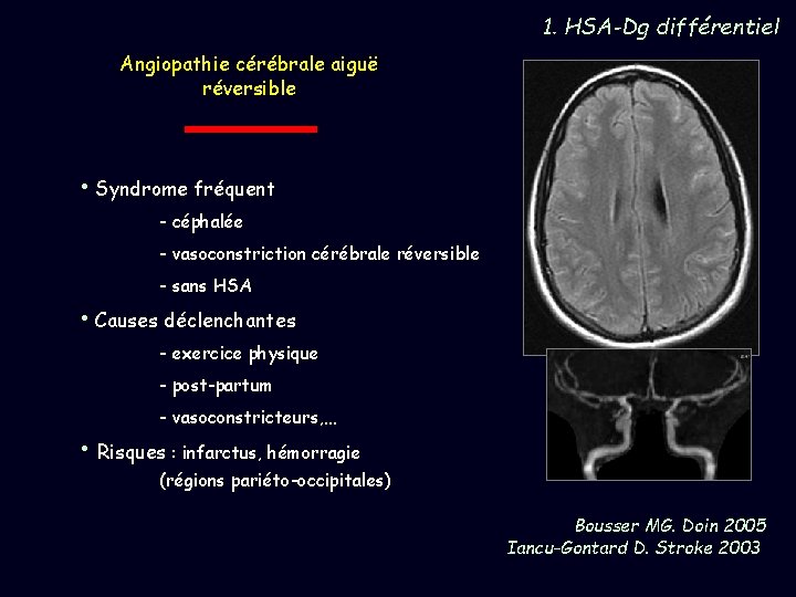 1. HSA-Dg différentiel Angiopathie cérébrale aiguë réversible • Syndrome fréquent - céphalée - vasoconstriction