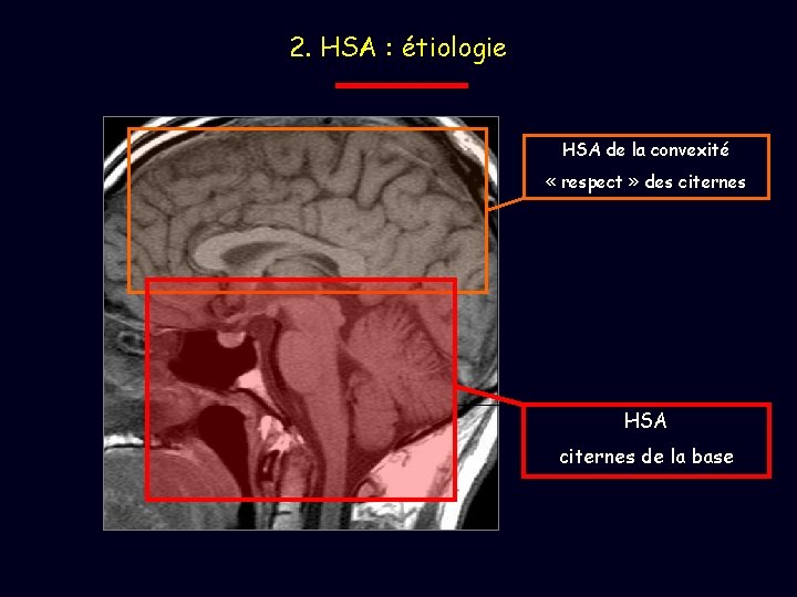 2. HSA : étiologie HSA de la convexité « respect » des citernes HSA