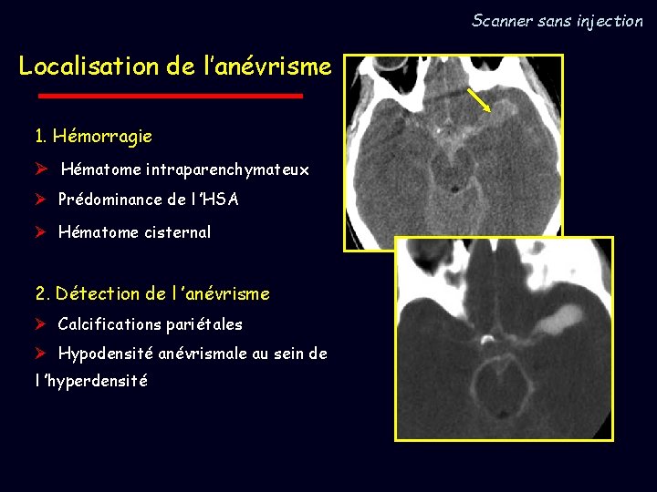 Scanner sans injection Localisation de l’anévrisme 1. Hémorragie Ø Hématome intraparenchymateux Ø Prédominance de