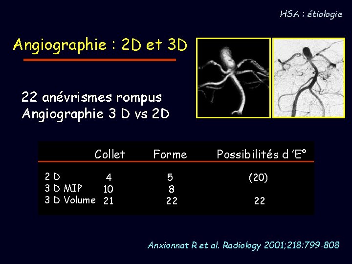 HSA : étiologie Angiographie : 2 D et 3 D 22 anévrismes rompus Angiographie