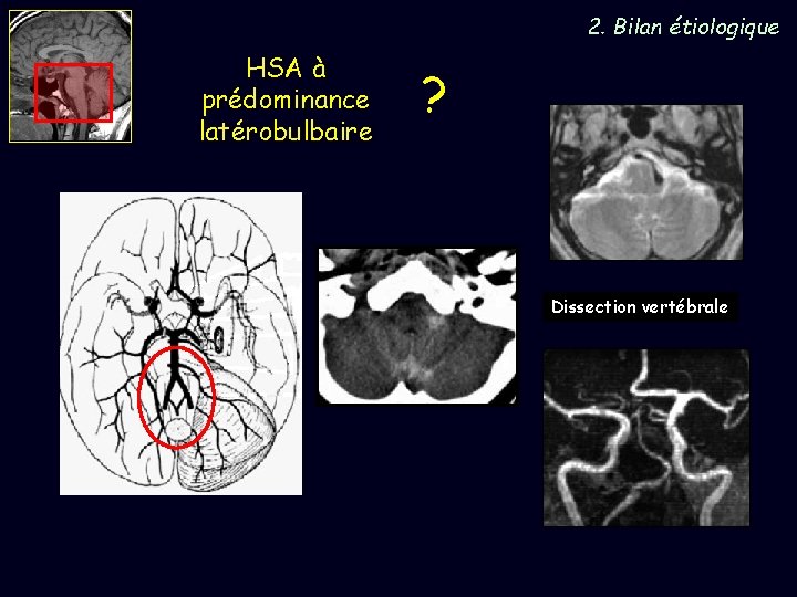 2. Bilan étiologique HSA à prédominance latérobulbaire ? Dissection vertébrale 