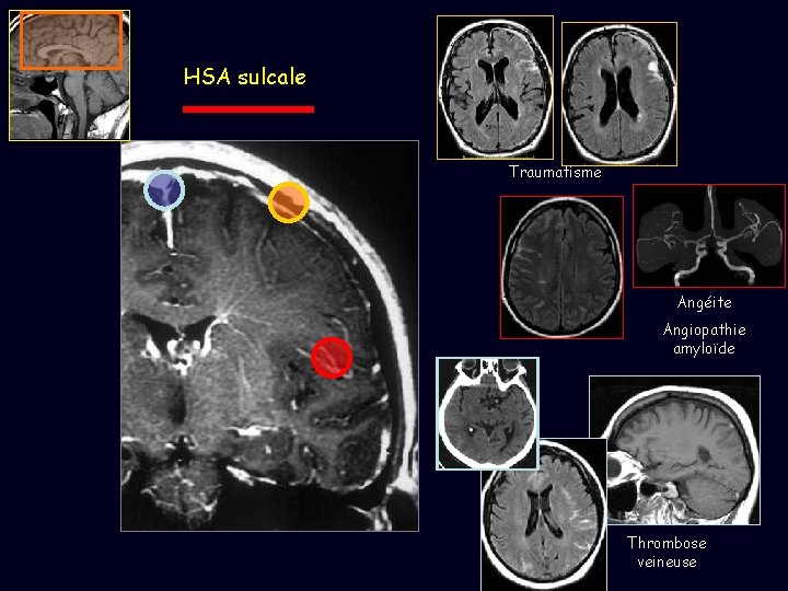 HSA sulcale Traumatisme Angéite Angiopathie amyloïde Thrombose veineuse 