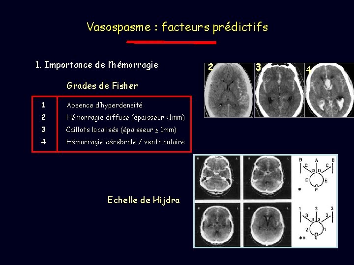 Vasospasme : facteurs prédictifs 1. Importance de l’hémorragie Grades de Fisher 1 Absence d’hyperdensité