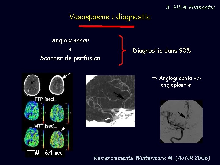 Vasospasme : diagnostic Angioscanner + Scanner de perfusion 3. HSA-Pronostic Diagnostic dans 93% ⇒