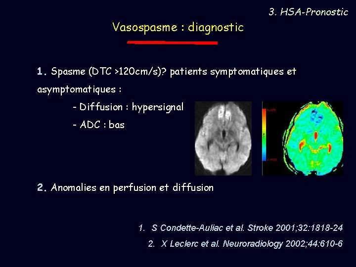 Vasospasme : diagnostic 3. HSA-Pronostic 1. Spasme (DTC >120 cm/s)? patients symptomatiques et asymptomatiques