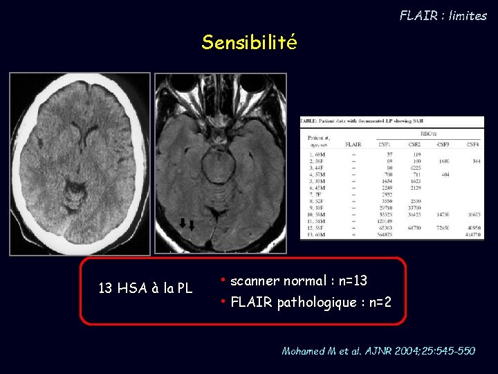 FLAIR : limites Sensibilité 13 HSA à la PL • scanner normal : n=13